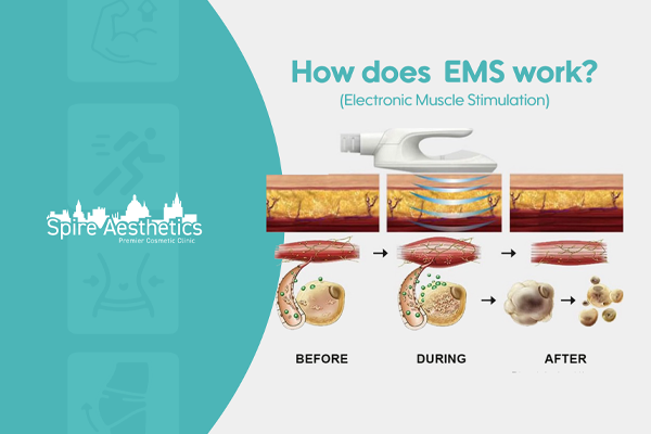EMS treatment for post pregnancy weight loss treatment Chipping Norton
