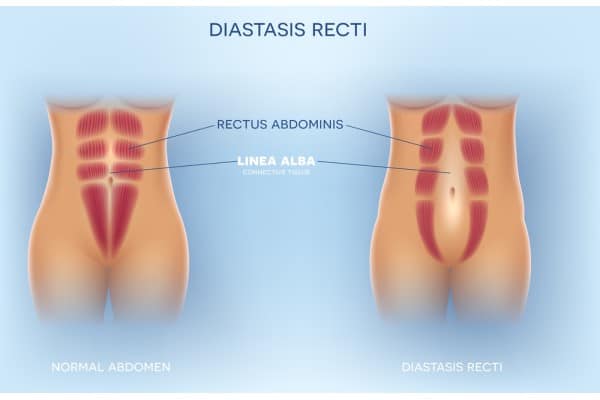 What Non-Surgical Options Are Available for Diastasis Recti Chipping Norton?