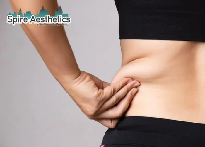Image of woman pinching fat on their hips Chipping Norton. Fat Freezing treatment