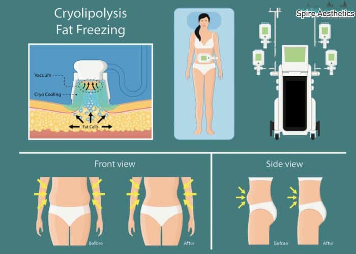 Image of diet and fat freezing combined for best results for Spire Aesthetics Chipping Norton