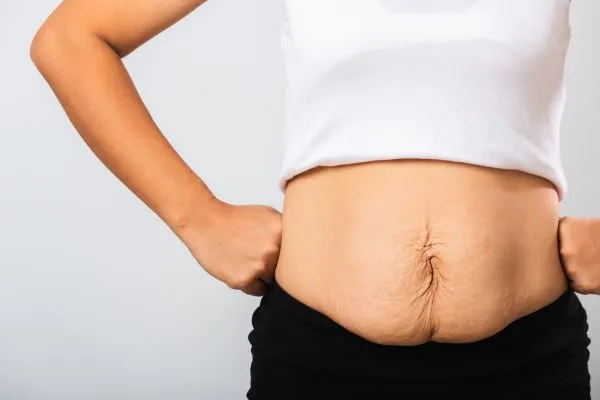 Image of a woman's stomach after weight loss with sagging skin following a gastric band Chipping Norton