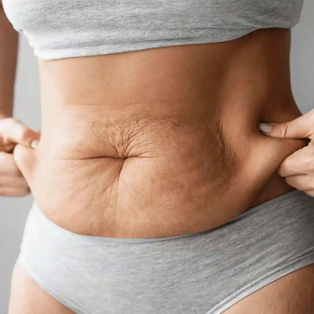 Is It Normal to Have Loose Skin After Pregnancy Chipping Norton?