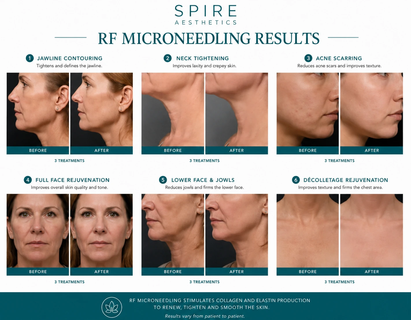 RF Microneedling Skin tightening Chipping Norton results