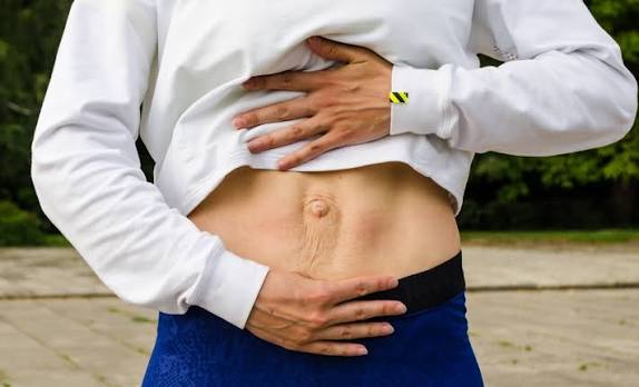 When Could Diastasis Recti Be the Missing Piece of the Puzzle Chipping Norton?