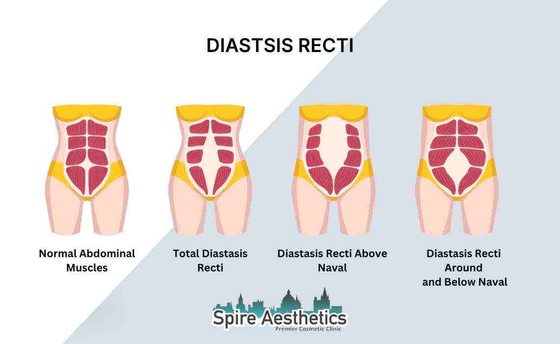 Is Non-Surgical Diastasis Recti Treatment Right for You? Common Concerns Answered Chipping Norton